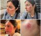 Divya Khosla Kumar Injured During Shooting Of Her Next